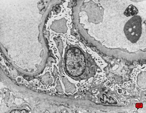 F,70y. | nephrotic syndrome: minimal changes - fusion of pedicles